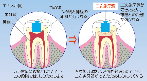 歯の組織図（第二象牙質）