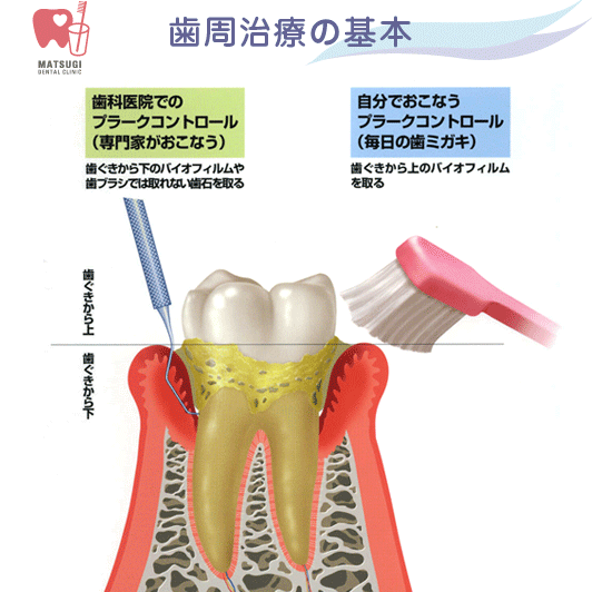 歯周治療の基本