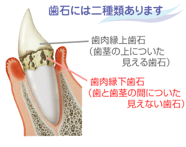 歯石の説明図