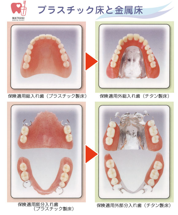 入れ歯の床の材質